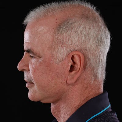 Neck Lift Before & After Gallery - Patient 261710 - Image 2
