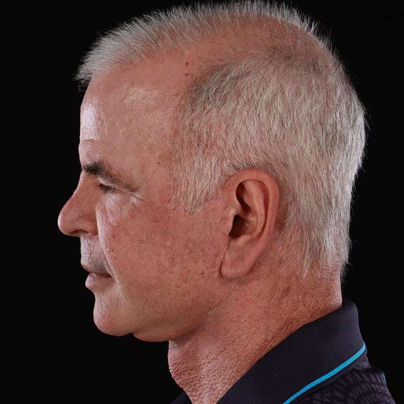 Facelift Before & After Gallery - Patient 424295 - Image 10