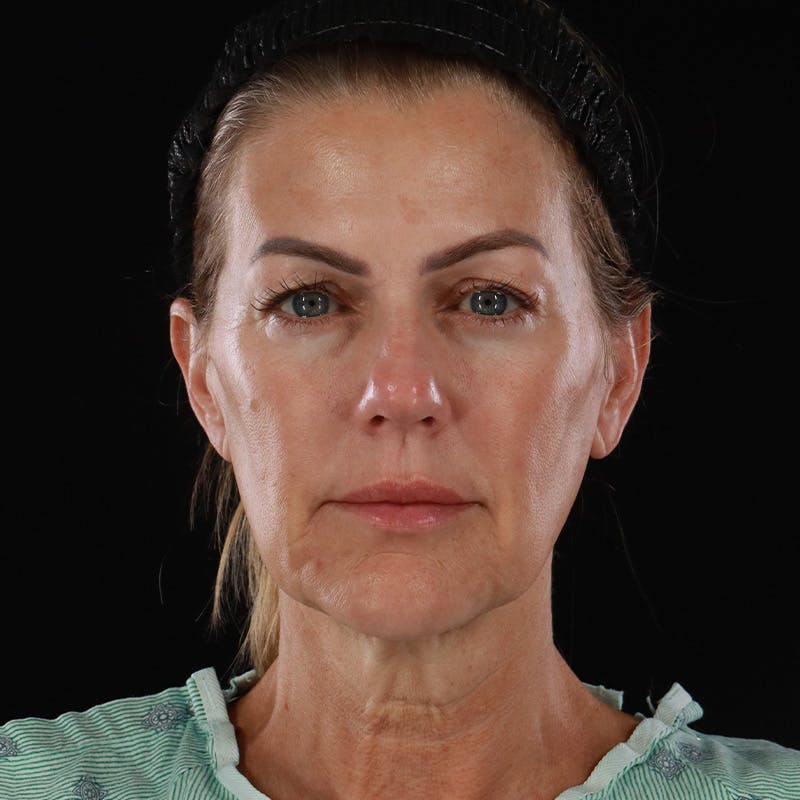 Facelift Before & After Gallery - Patient 975442 - Image 1