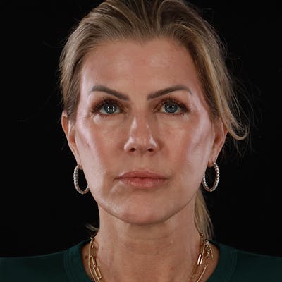 Contour Total Resurfacing Laser Before & After Gallery - Patient 270031 - Image 2