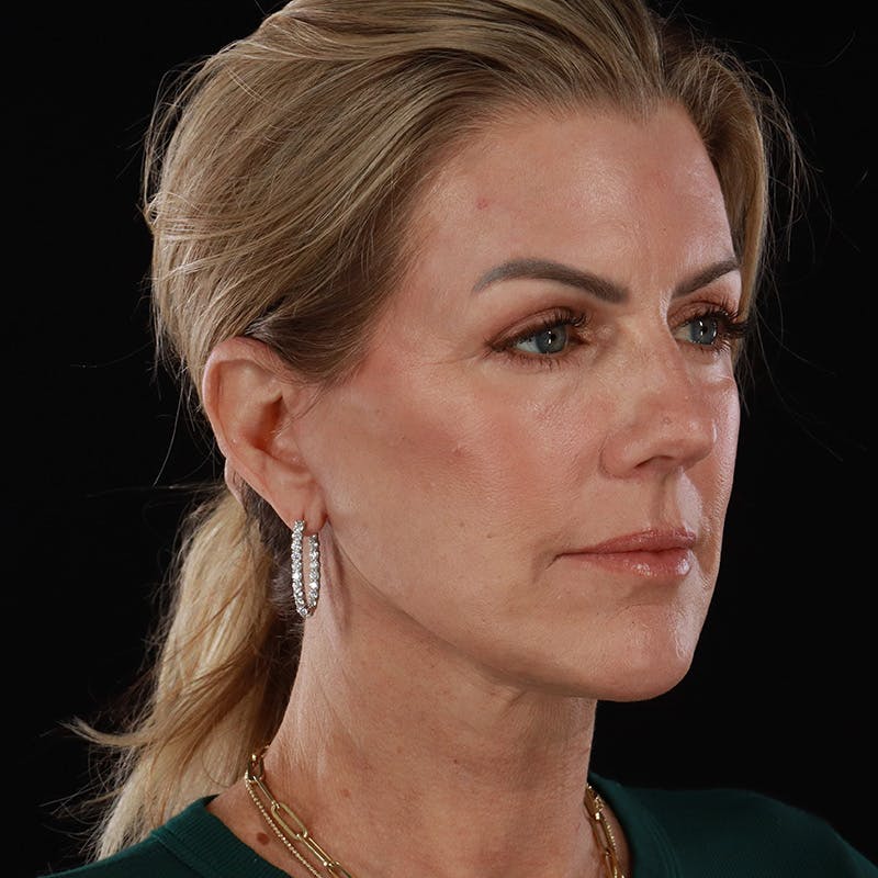 Facelift Before & After Gallery - Patient 975442 - Image 4