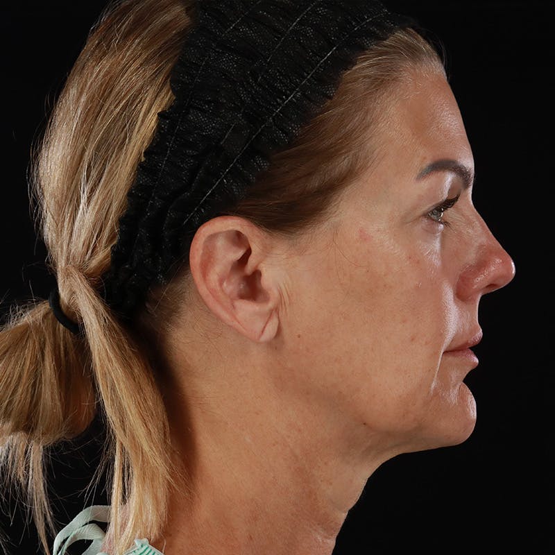 Facelift Before & After Gallery - Patient 975442 - Image 5