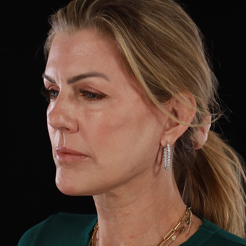 Facelift Before & After Gallery - Patient 975442 - Image 8