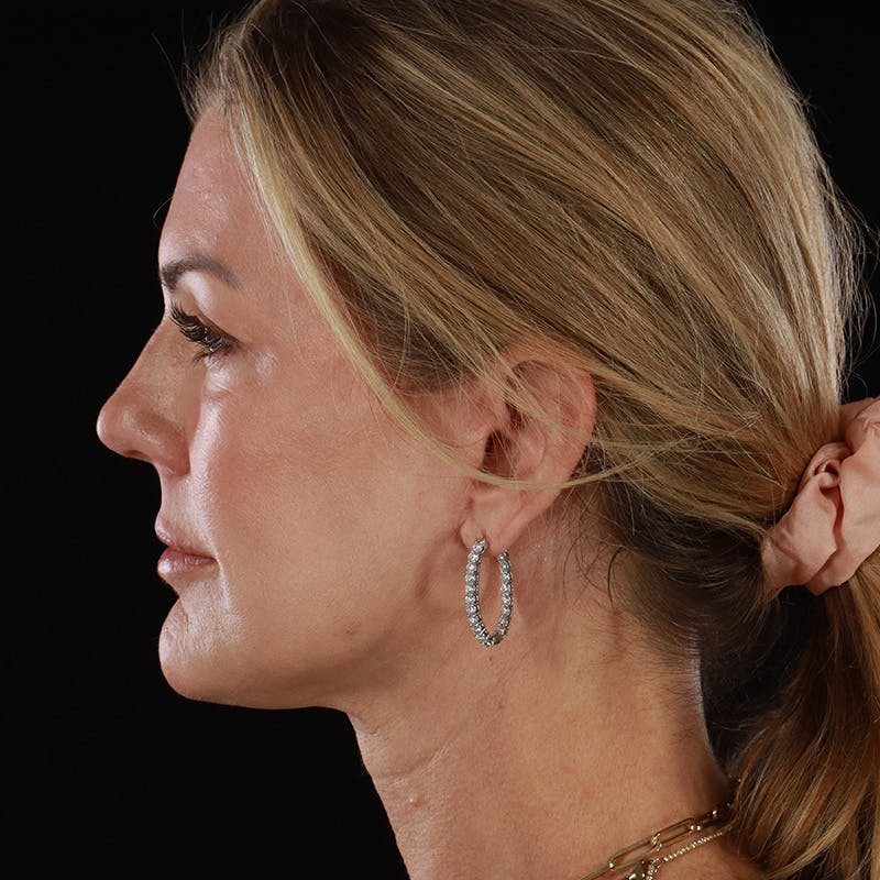 Facelift Before & After Gallery - Patient 975442 - Image 10