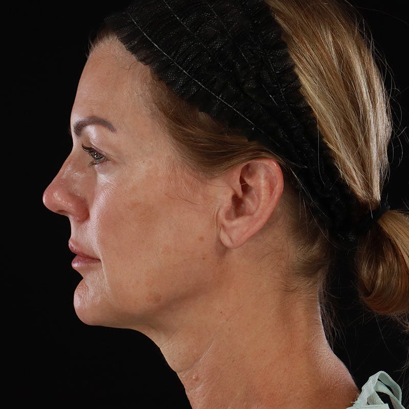 Facelift Before & After Gallery - Patient 975442 - Image 9