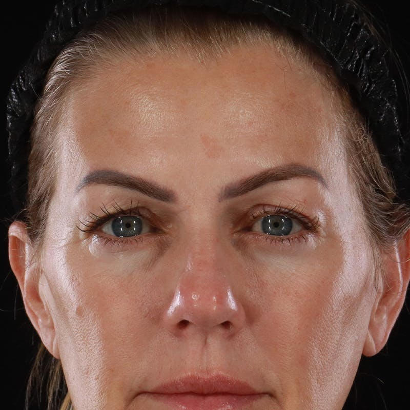 Upper Eyelid Surgery Before & After Gallery - Patient 621460 - Image 1