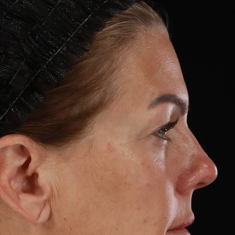 Upper Eyelid Surgery Before & After Gallery - Patient 621460 - Image 5