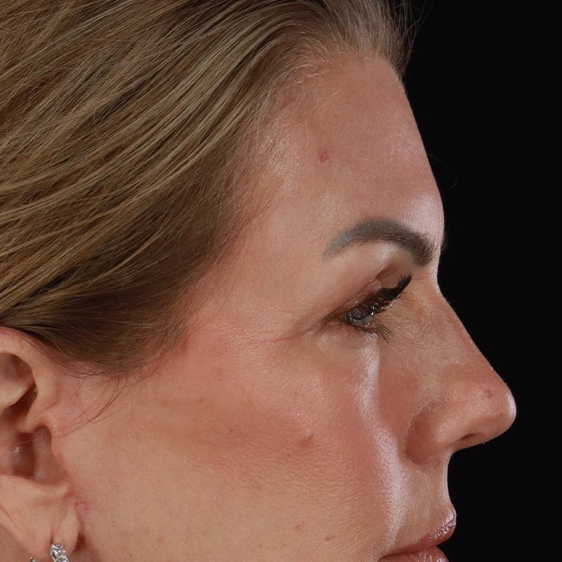 Upper Eyelid Surgery Before & After Gallery - Patient 621460 - Image 6