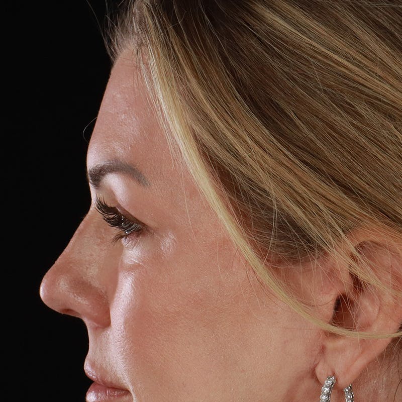 Upper Eyelid Surgery Before & After Gallery - Patient 621460 - Image 10