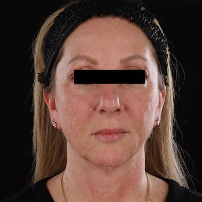 Contour Total Resurfacing Laser Before & After Gallery - Patient 138678 - Image 2