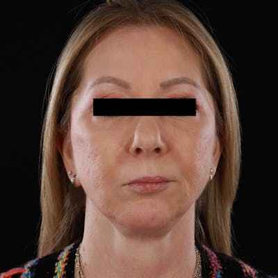 Contour Total Resurfacing Laser Before & After Gallery - Patient 138678 - Image 1