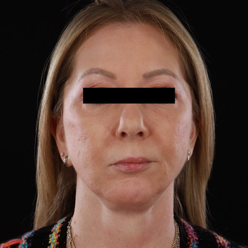 Facelift Before & After Gallery - Patient 175384 - Image 1