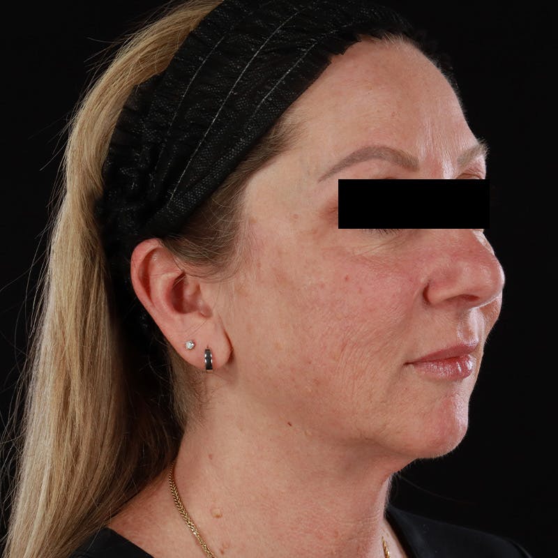 Facelift Before & After Gallery - Patient 175384 - Image 4