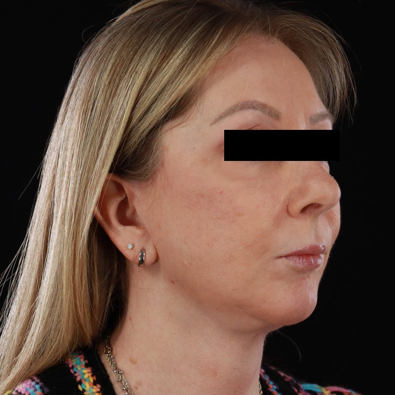 Facelift Before & After Gallery - Patient 175384 - Image 3