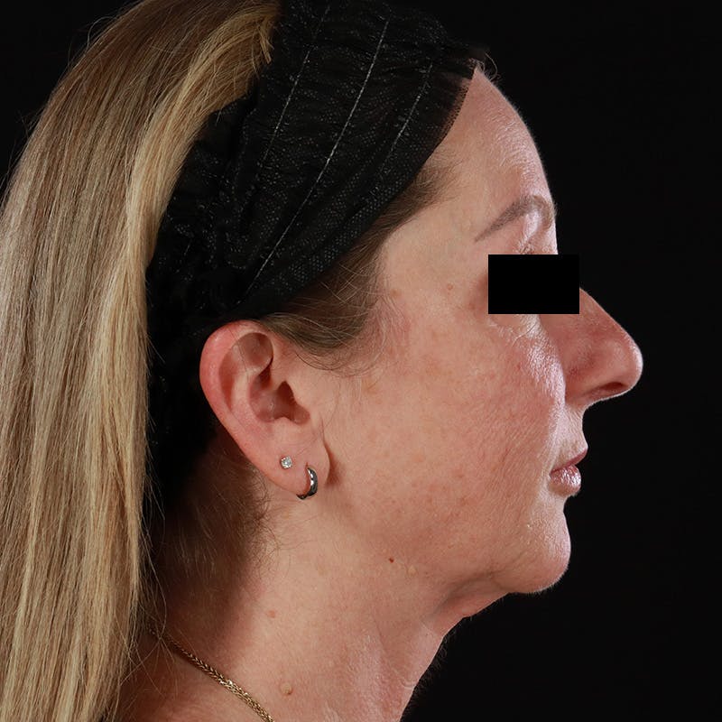 Facelift Before & After Gallery - Patient 175384 - Image 6