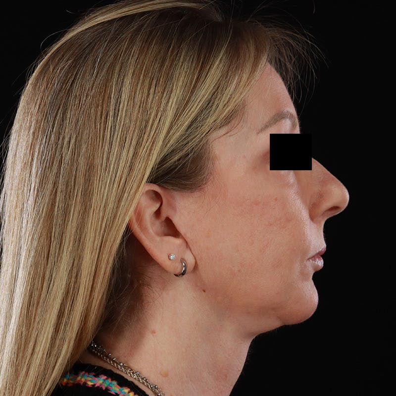 Facelift Before & After Gallery - Patient 175384 - Image 5