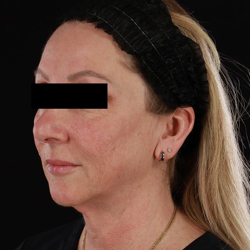 Facelift Before & After Gallery - Patient 175384 - Image 8