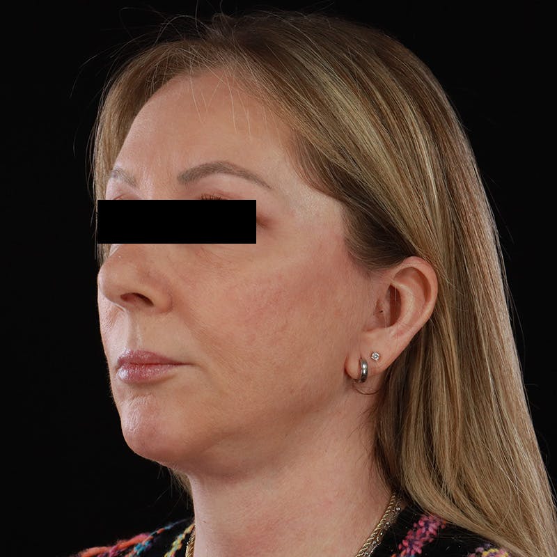 Facelift Before & After Gallery - Patient 175384 - Image 7