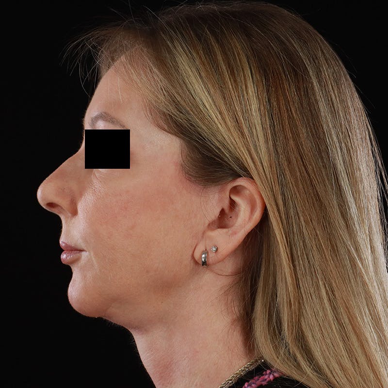 Facelift Before & After Gallery - Patient 175384 - Image 9