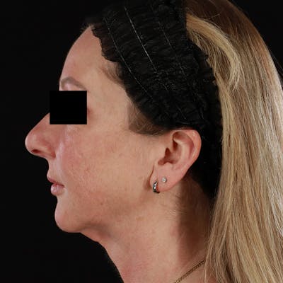 Neck Lift Before & After Gallery - Patient 287932 - Image 2