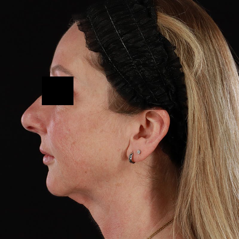 Facelift Before & After Gallery - Patient 175384 - Image 10