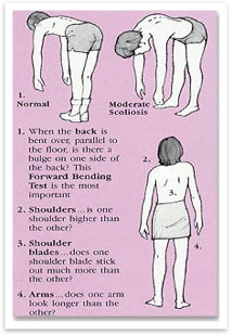 scoliosis diagram image