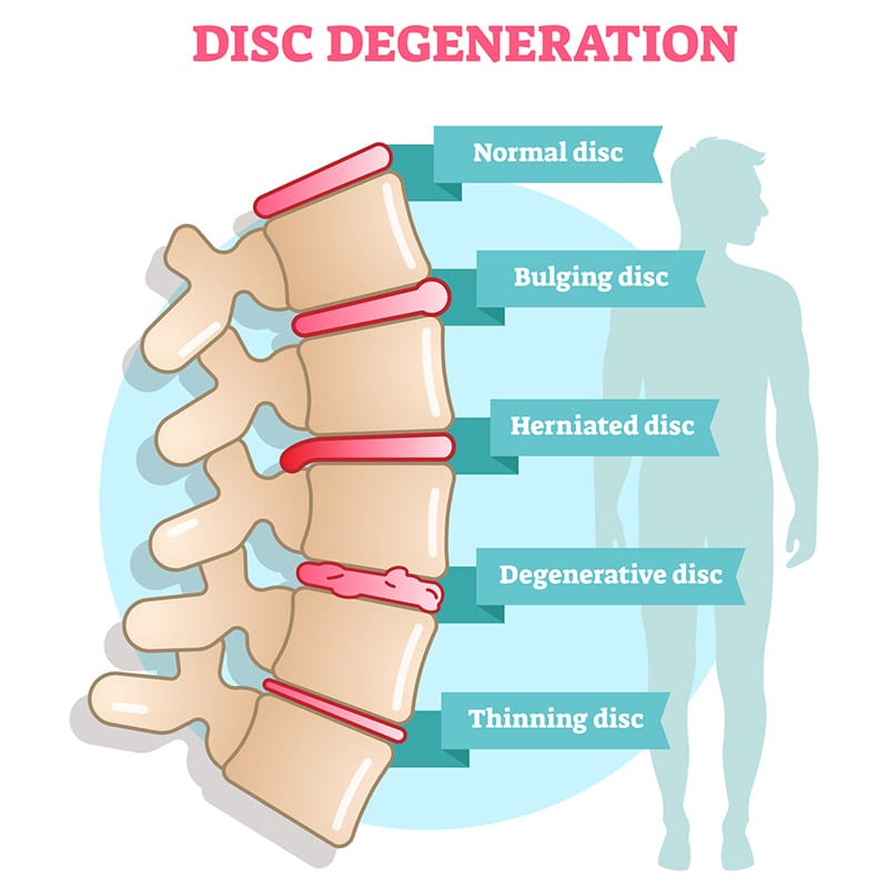 Disc degeneration diagram image