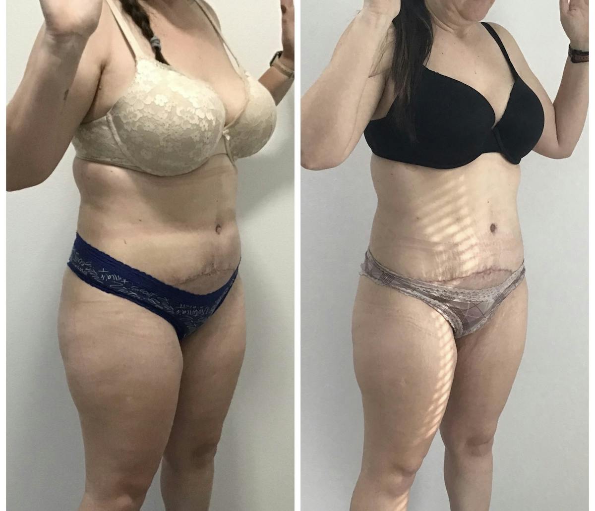 Weight Loss Shots Before & After Gallery - Patient 175541432 - Image 1