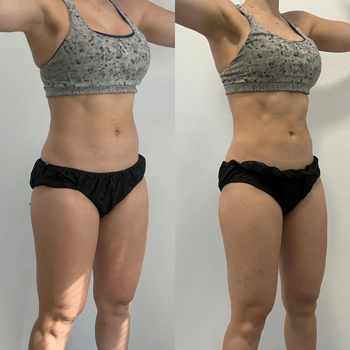 Weight Loss Shots Before & After Gallery - Patient 186758395 - Image 1