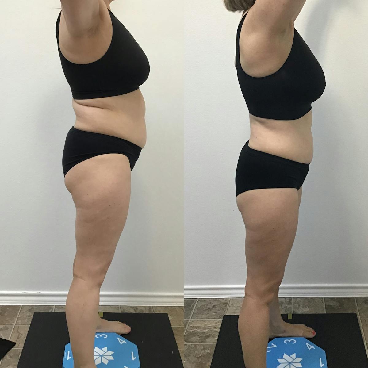 Weight Loss Shots Before & After Gallery - Patient 227200 - Image 1