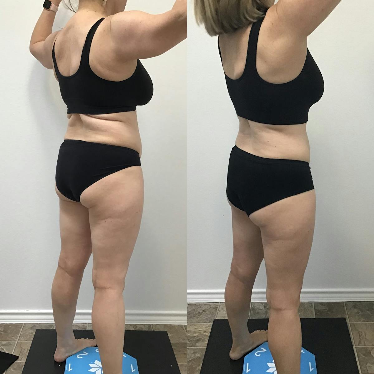 Weight Loss Shots Before & After Gallery - Patient 122812 - Image 1