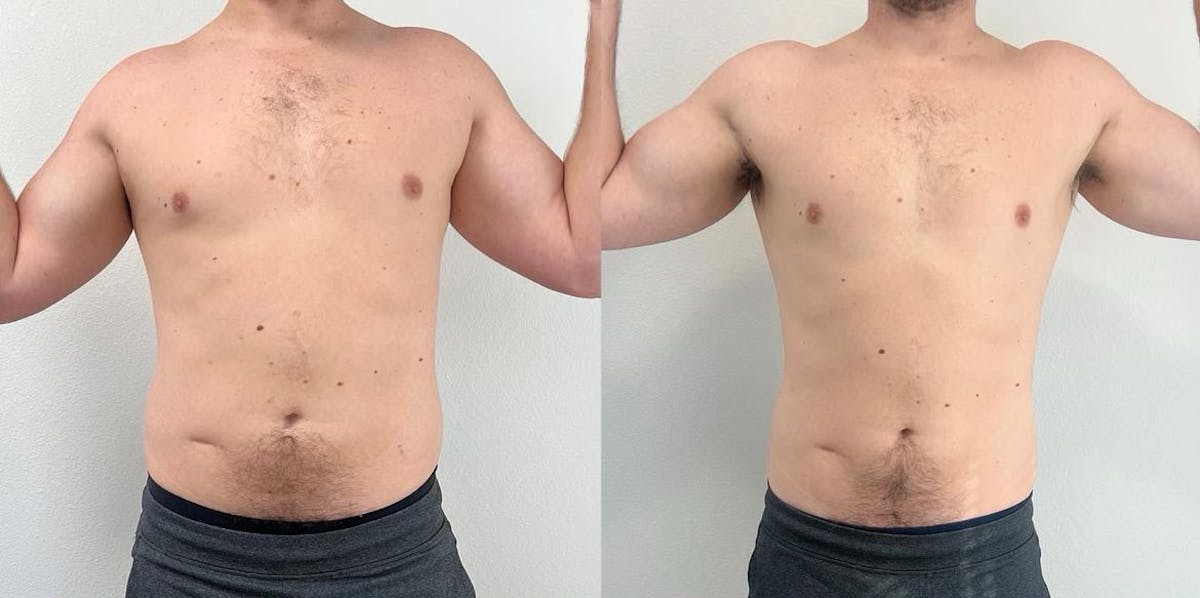 Weight Loss Shots Before & After Gallery - Patient 324095 - Image 1