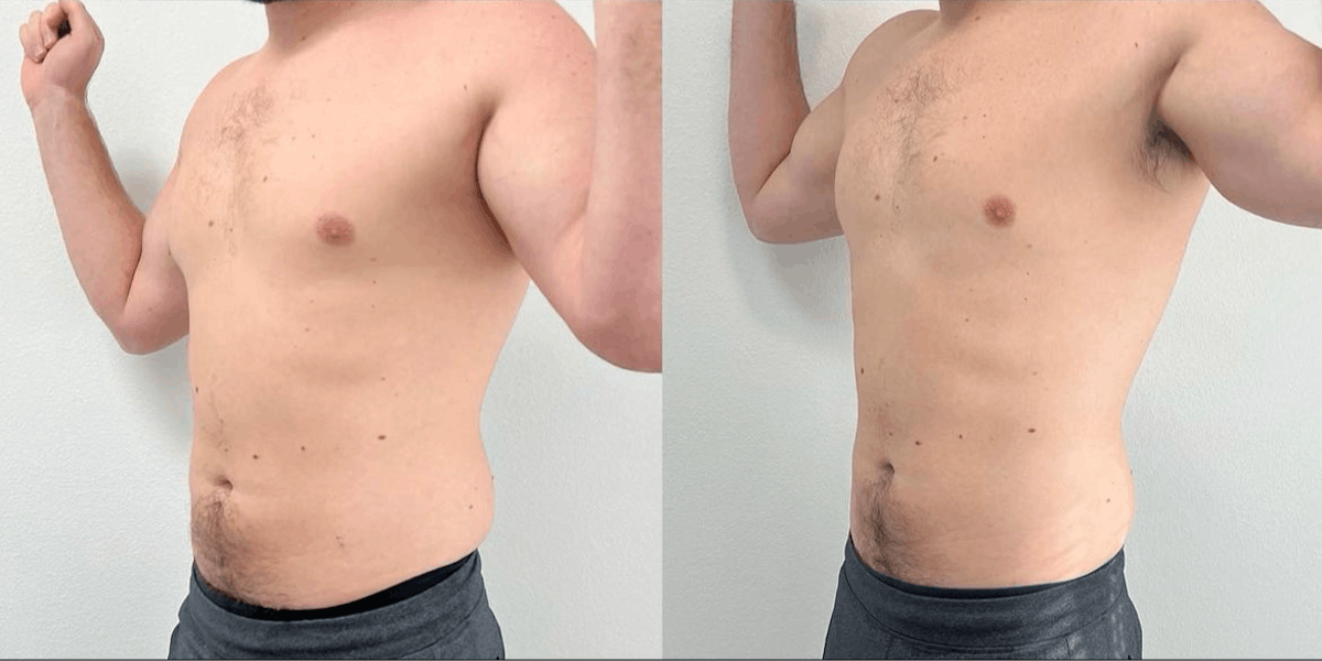 Weight Loss Shots Before & After Gallery - Patient 683947 - Image 1