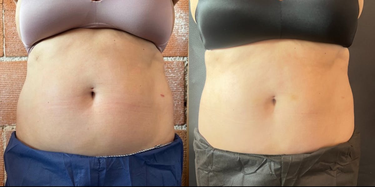Weight Loss Shots Before & After Gallery - Patient 175541430 - Image 1