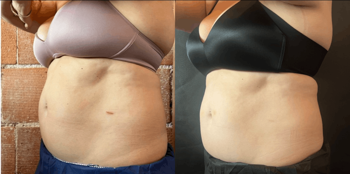 Weight Loss Shots Before & After Gallery - Patient 271205 - Image 1