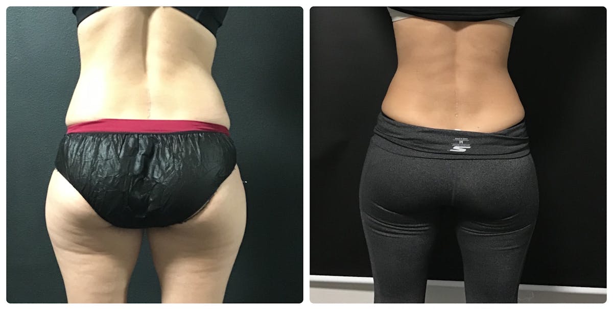Weight Loss Shots Before & After Gallery - Patient 224095 - Image 1