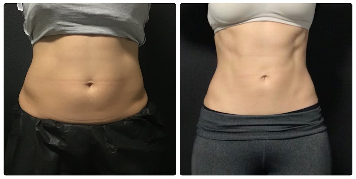 Weight Loss Shots Before & After Gallery - Patient 358299 - Image 1