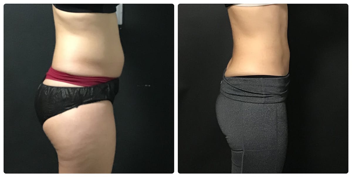 Weight Loss Shots Before & After Gallery - Patient 408656 - Image 1