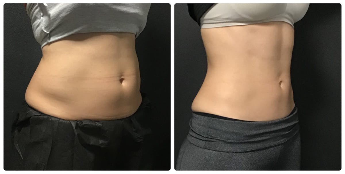 Weight Loss Shots Before & After Gallery - Patient 175541431 - Image 1