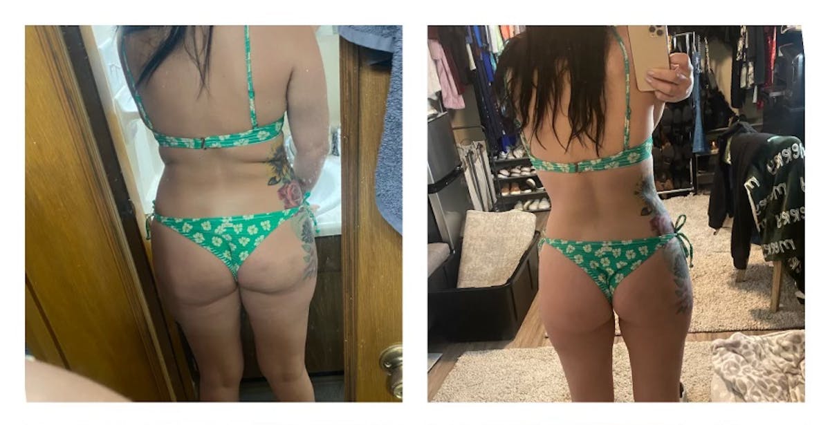 Weight Loss Shots Before & After Gallery - Patient 175541433 - Image 1