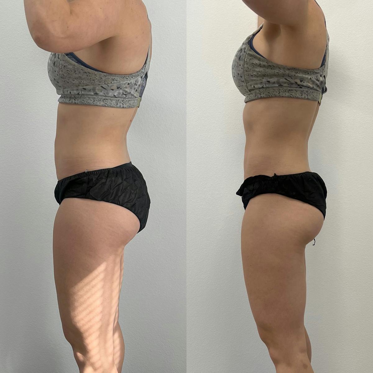 Weight Loss Shots Before & After Gallery - Patient 197718 - Image 1