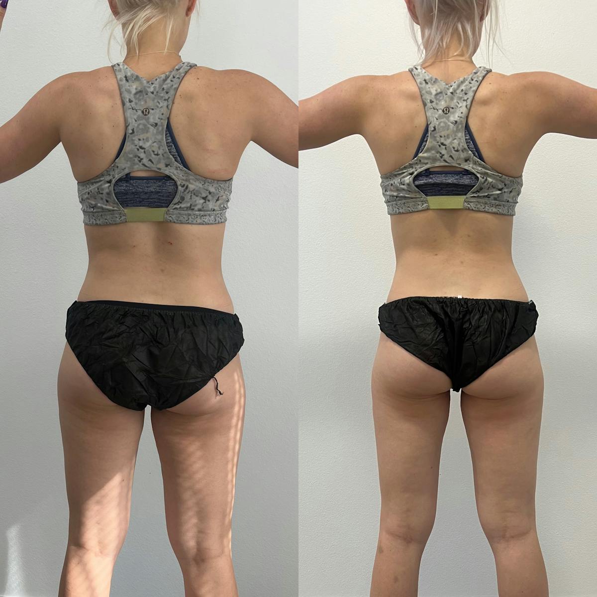 Weight Loss Shots Before & After Gallery - Patient 133040 - Image 1