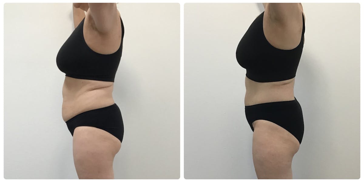 Weight Loss Shots Before & After Gallery - Patient 112563 - Image 1
