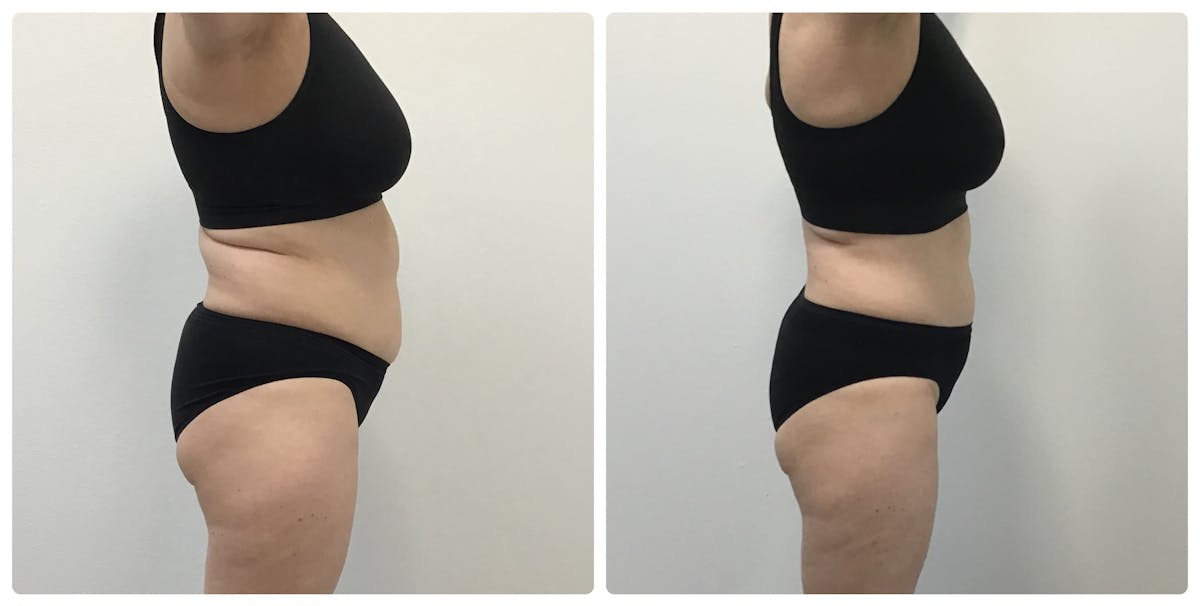 Weight Loss Shots Before & After Gallery - Patient 277056 - Image 1