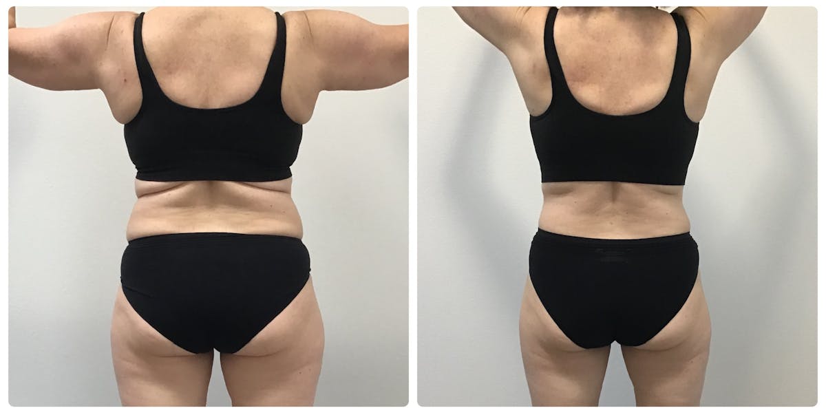 Weight Loss Shots Before & After Gallery - Patient 241531 - Image 1
