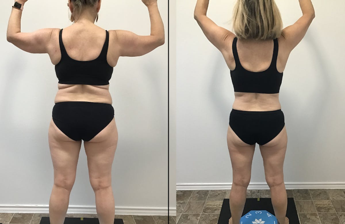 Weight Loss Shots Before & After Gallery - Patient 193562 - Image 1