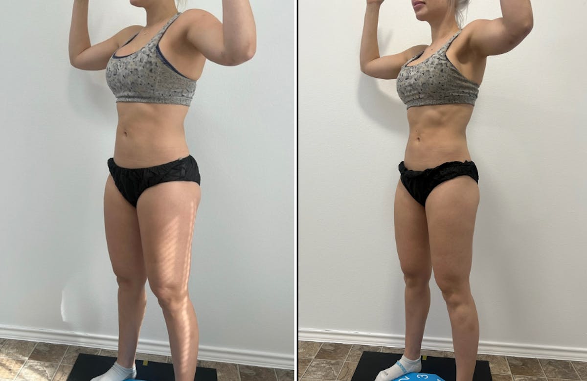 Weight Loss Shots Before & After Gallery - Patient 149746 - Image 1