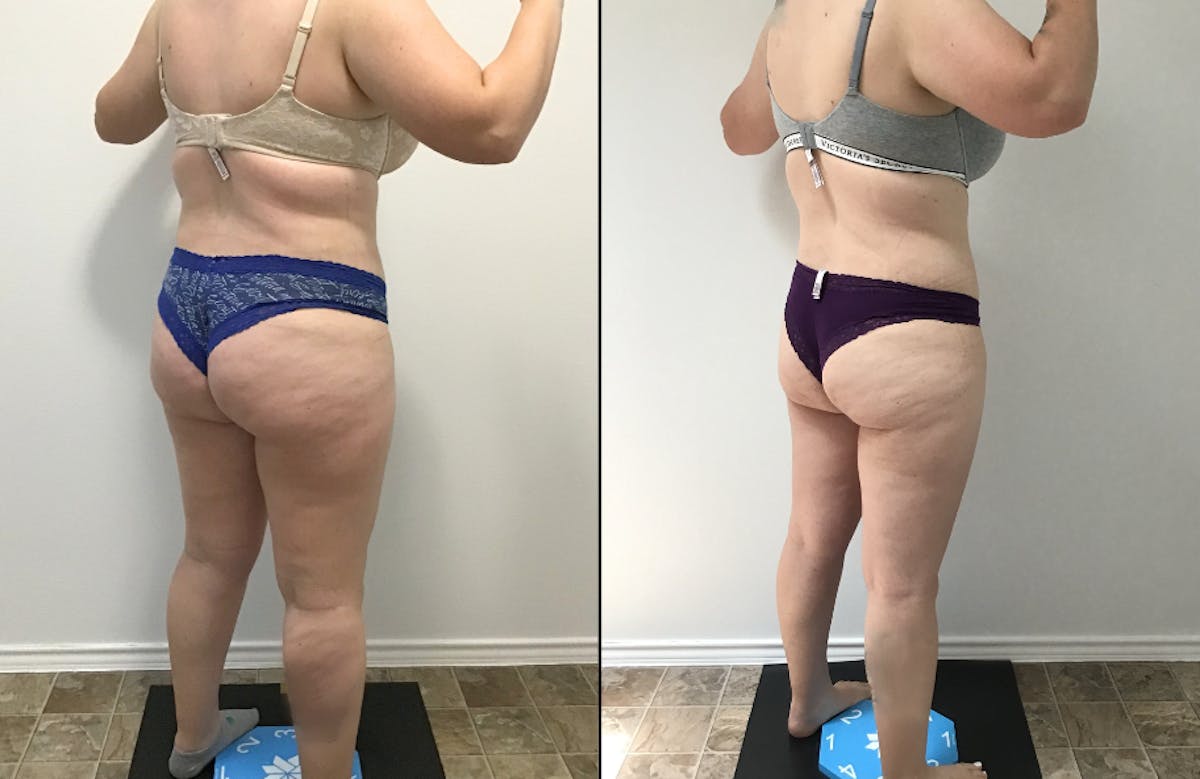 Weight Loss Shots Before & After Gallery - Patient 131294 - Image 1