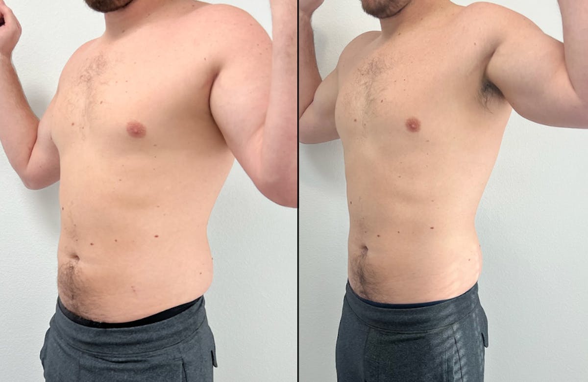 Weight Loss Shots Before & After Gallery - Patient 347832 - Image 1