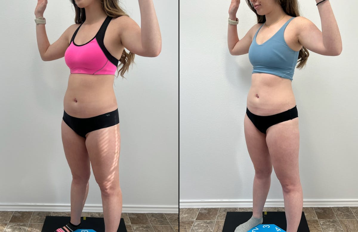 Weight Loss Shots Before & After Gallery - Patient 393195 - Image 1